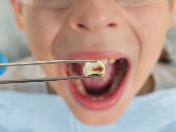 Best Broken or Cracked Tooth Emergency Dentist in Wind Gap, PA